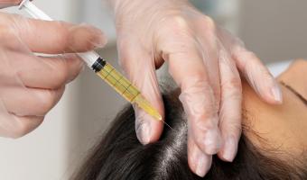 Уникальная процедура для здоровья и густоты волос – плазмолифтинг