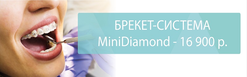 Брекет-система MiniDiamond – 16 900 ₽