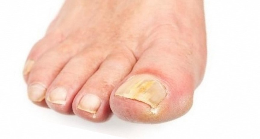 Грибковые заболевания стоп и ногтей